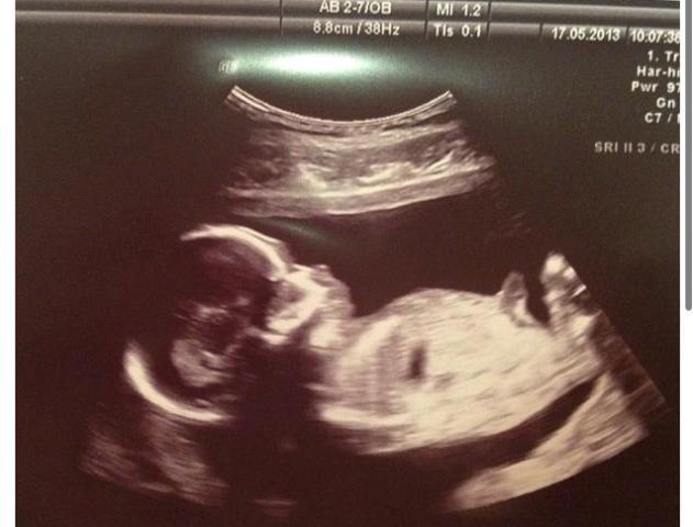 Snimka ultrazvuka: Nika Antolos nosi djevojčicu!